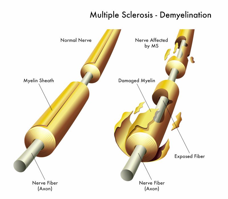 Illustrazione medica 3d che confronta un nervo sano e uno danneggiato dalla sclerosi multipla Illustrazione medica 3d che confronta un nervo sano e uno danneggiato dalla sclerosi multipla